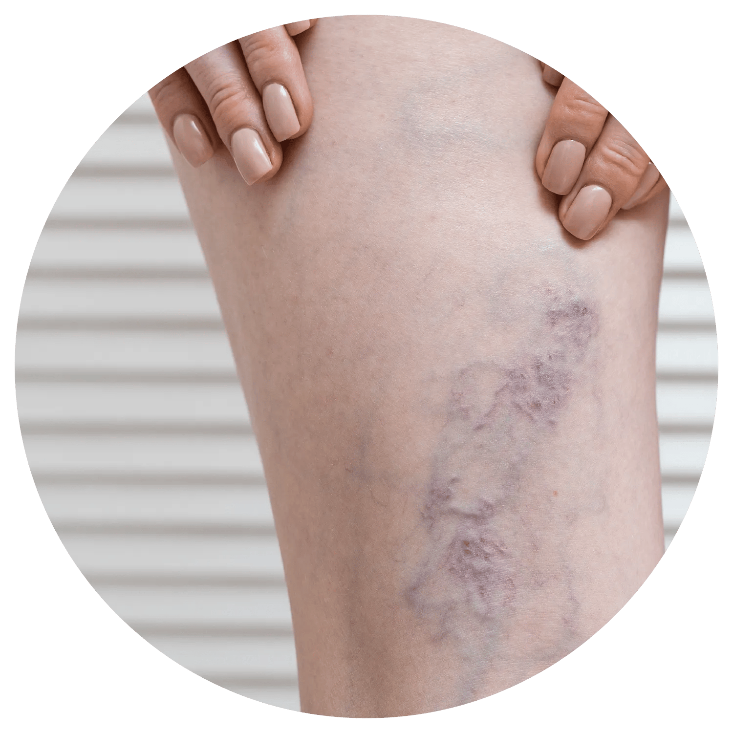 Spider Veins treatment results at Toronto medical spa - The Chain Reaction of Symptoms